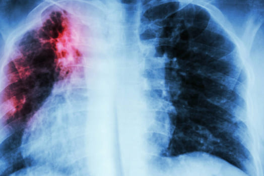 El mesotelioma es un cáncer poco común pero altamente agresivo que afecta el revestimiento de los pulmones (pleura) o el abdomen (peritoneo). Es causado casi exclusivamente por la exposición al amianto y puede desarrollarse décadas después de la exposición inicial. Los síntomas del mesotelioma incluyen dificultad para respirar, dolor en el pecho, fatiga, pérdida de peso y acumulación de líquido en la cavidad pleural o abdominal. Esta enfermedad tiene un pronóstico sombrío y el tratamiento suele ser paliativo, con una esperanza de vida limitada