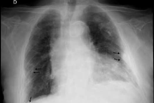 Las enfermedades que provoca la uralita son pulmonares Las enfermedades que provoca la uralita son pulmonares